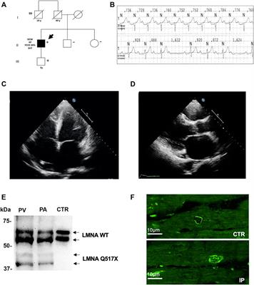 Role of Nuclear Lamin A/C in the Regulation of Nav1.5 Channel and Microtubules: Lesson From the Pathogenic Lamin A/C Variant Q517X